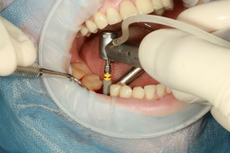 tratamiento implantologia dental